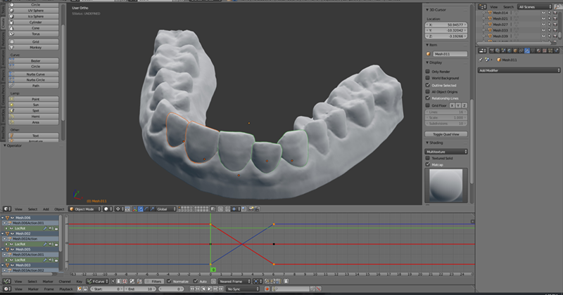 3D打印自制牙套：跟高价牙医说拜拜！